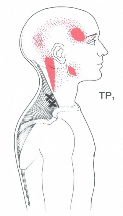 Image of myofascial trigger points of upper trapezius that may cause headaches