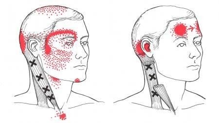 Image of myofascial trigger points in Sternocleidomastoid that may cause headaches